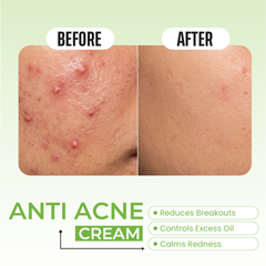 ANTI ACNE CREAM