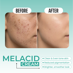 Melacid Cream